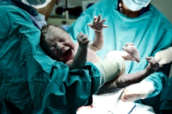 תשניק סב לידתי - Intrauterine hypoxia